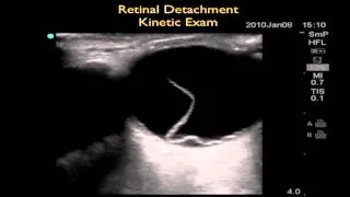 How to Case Study Occular Ultrasound Part 2