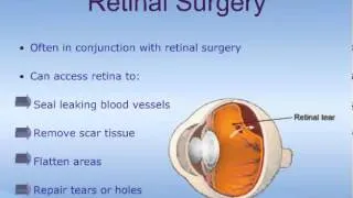 Vitrectomy