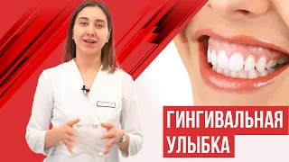 Десневая улыбка. Ботокс при гингивальной улыбки.