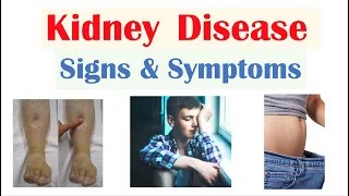 Kidney (Renal) Disease Signs & Symptoms (ex. Peripheral Edema, Fatigue, Itchiness)