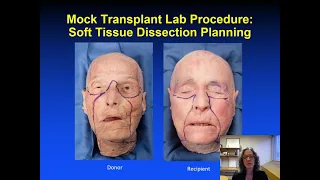 Periocular Aspects of Face Transplantation Surgery -- Presented by Elizabeth Bradley, MD