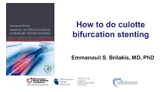 How to do culotte bifurcation stenting