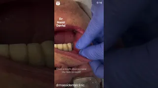 Dental abscess, cheek swelling