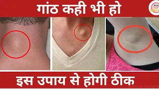 अमृत है यह पोटली इसे बांधने से कैसी भी गांठ है।बर्फ की तरह पिघल जाएगी |Lipoma cure