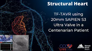 TF-TAVR using 20mm SAPIEN S3 Ultra Valve in a Centenarian Patient