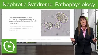 Nephrotic Syndrome: Pathophysiology with Case– Nephrology | Lecturio