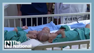 One of the Yemeni conjoined twins has died after 15-hour operation