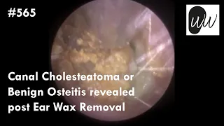 565 - Canal Cholesteatoma or Benign Osteitis revealed Post Ear Wax Removal