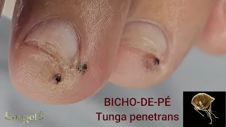 Removendo 3 bichos-de-pé #satisfying