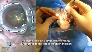 5x Bilateral simultaneous Femto laser-assisted cataract surgery (FLACS) for Hypermature Intumescent