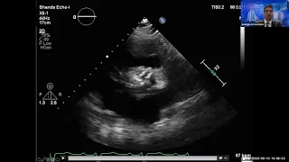 Heart valve problems? You have options [Free webinar]