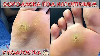 Wart on the foot of a teenager / Corns on the feet