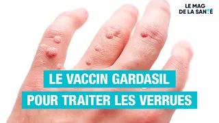 🧐 Des PAPILLOMAVIRUS responsables des verrues ? - Allo Docteurs