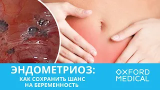 Эндометриоз. Как сохранить шанс на беременность.