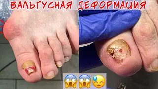 Hallux valgus and onychogryphosis with inflammation under the nail