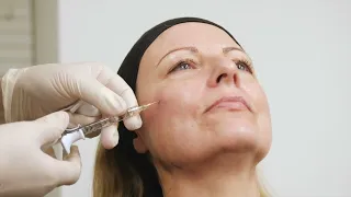 Correction of under eye bags with volume in the cheek and eyelid