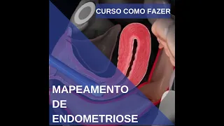 Curso de Ultrassonografia para pesquisa de endometriose. Aula 34. exclusiva para médicos