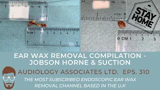 EAR WAX REMOVAL COMPILATION - JOBSON HORNE & SUCTION - EP 310