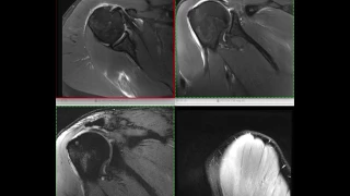 Плечо 27 04 2017 отрыв вращательной манжеты, SLAP, артроз плеча и АКс