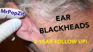 Ear blackhead extractions! 2 year follow up of my most viewed video. 1st video linked below