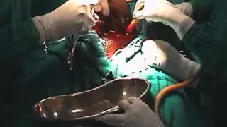 Caesarean Section: Delivery of the baby and placenta and cleaning the uterine cavity