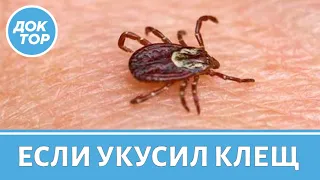 Что делать, если укусил клещ? Первая помощь