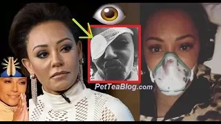 Mel B Went Blind in Eye After Alleged Herpes Flare Up & Shuts Down Rumors ! 👁️👀
