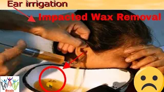Impacted Wax removal at home or hospital / hard wax removal at  home