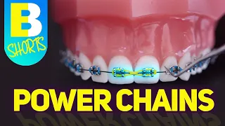 Braces Power Chains Explained #Shorts