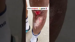 Skating Race Accident 🤕 #skate #skating #youtube #youtubeshorts #shortsvideo #sport #india