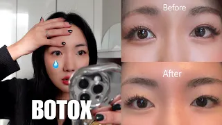 Botox made my eyes SMALLER?! my experience + thoughts