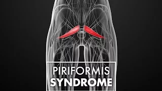 Piriformis Syndrome Explained | Dr. Mark LeDoux | Top10MD