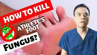 How to kill athlete's foot fungus?