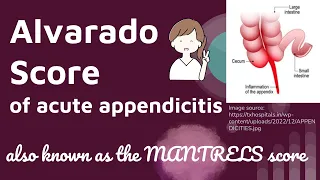 Alvarado Score of acute appendicitis| MANTRELS score |Novice Medic