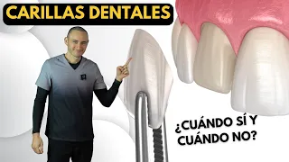 Carillas dentales de porcelana | Indicaciones y contraindicaciones