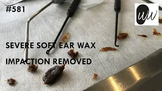 581 - Severe Soft Ear Wax Impaction Removed