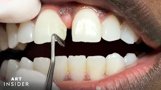 How Tooth Gaps Are Filled | Insider Art