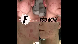 MY ACNE JOURNEY | MENTAL HEALTH AND BULLYING |