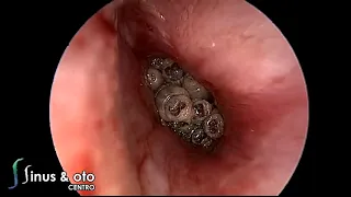 Myiasis of the ear -Myiasis of the ear