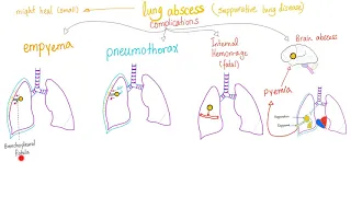 Lung Infection; Lung Abscess, Aspiration Syndromes, Systemic fungi