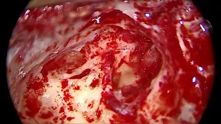 Mastoidectomy with Facial nerve Decompression