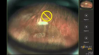 Navilas® Laser System 577s - Contact free navigated laser retinopexy treatment