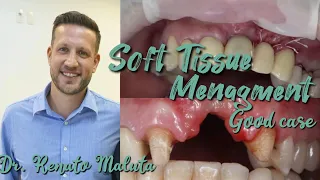 Soft tissue management in dentistry. Dr. Renato Maluta