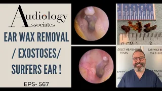 EXOSTOSES/SURFERS EAR/EAR WAX REMOVAL - EP567