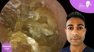 1,105 - Huge Ear Canal Crater Ear Wax Removal