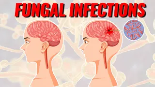 Deadly Fungal Infections Spreading