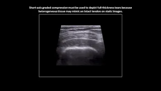 Full-thickness tear of the supraspinatus tendon on shoulder ultrasound (case 4)