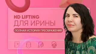 Пациентка Ирина: СМАС-лифтинг и процесс реабилитации