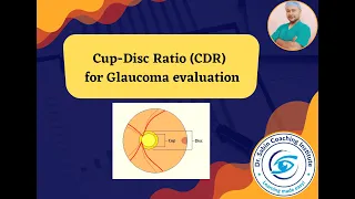 What is Cup-Disc Ratio (CDR) in Glaucoma evaluation?