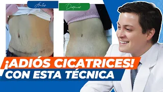 Cómo quitar las cicatrices post-quirúrgicas - Medicina estética en Perú